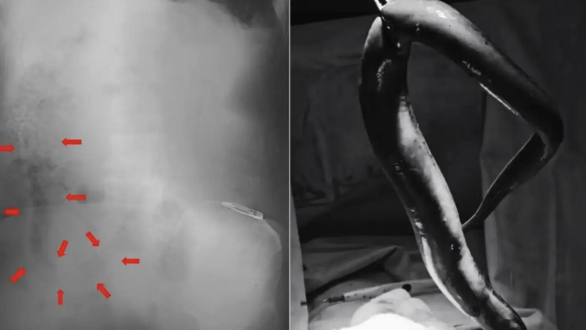 Penampakan belut yang terperangkap di dalam perut pria 55 tahun, sampai membuat usus berlubang. (Foto: International Journey of Surgery Case Reports)