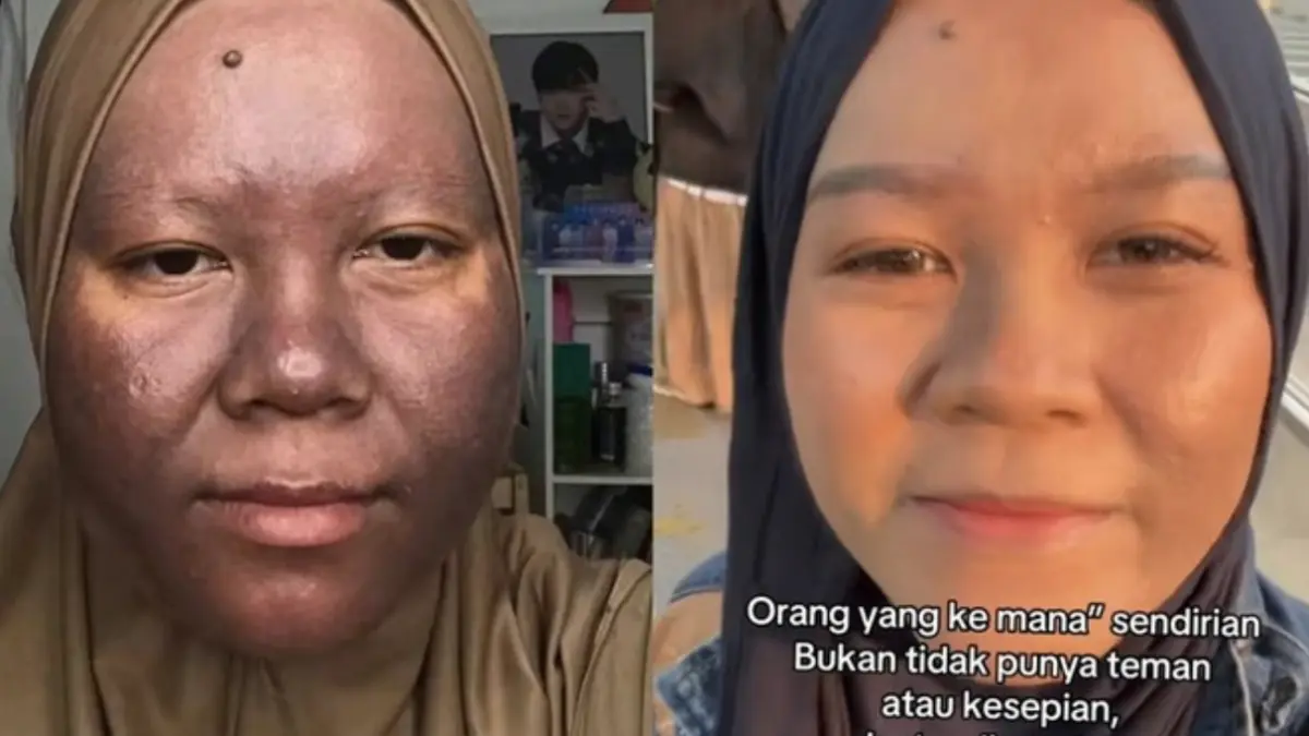 Wanita ini sukses kembalikan wajah sehatnya. (Foto: TikTok @nurnnyas dengan izin yang bersangkutan)