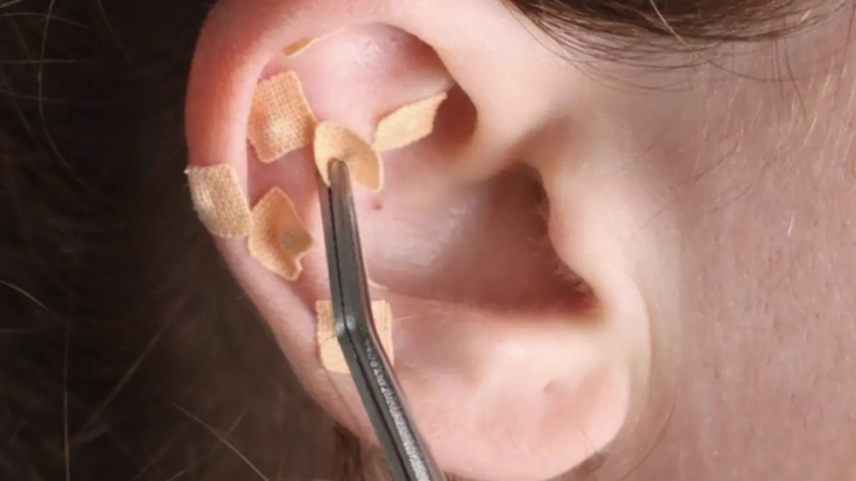 Tren ear seeds untuk meredakan stres. Bentuknya sih seperti patch. Foto: Getty Images/Jeniffer Fontan