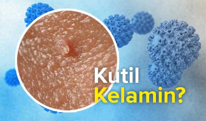 Kutil kelamin, penyakit menular seksual yang berbahaya.