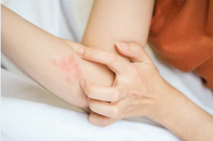 Ringworm dapat menginfeksi semua usia, mulai dari anak &ndash; anak sampai lansia.