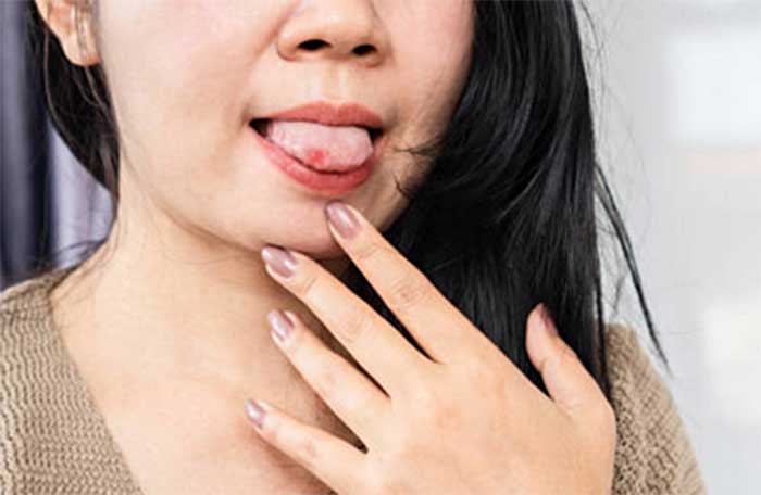 Tukak aphthous atau lebih dikenal dengan sariawan membuat penderitanya merasa tidak nyaman dan terganggu.