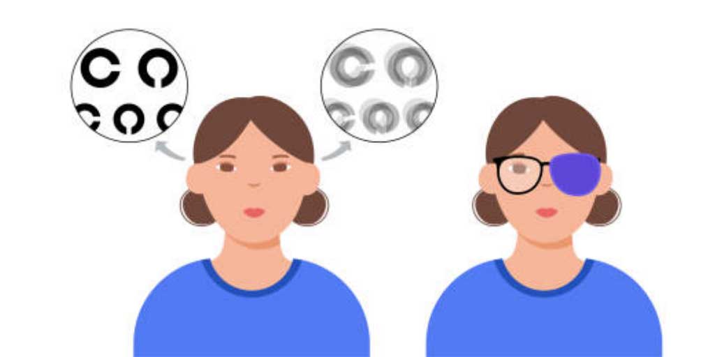 Lazy eye atau amblyopia bisa menyebabkan penglihatan buram permanen jika tidak ditangani sejak dini. Foto adalah ilustrasi.