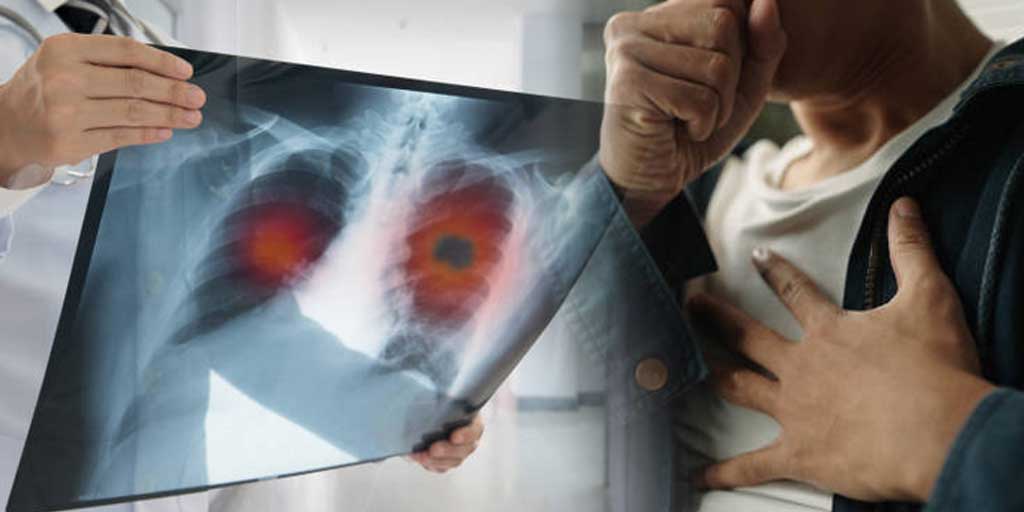 Kenali faktor risiko kanker serta langkah pencegahan yang bisa dilakukan sejak dini.