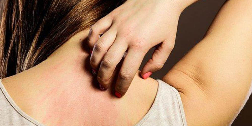 Seorang wanita menggaruk bagian punggung yang terasa gatal akibat cuaca panas. Kondisi ini sering dipicu oleh biang keringat atau alergi panas yang membuat kulit iritasi dan terasa perih.