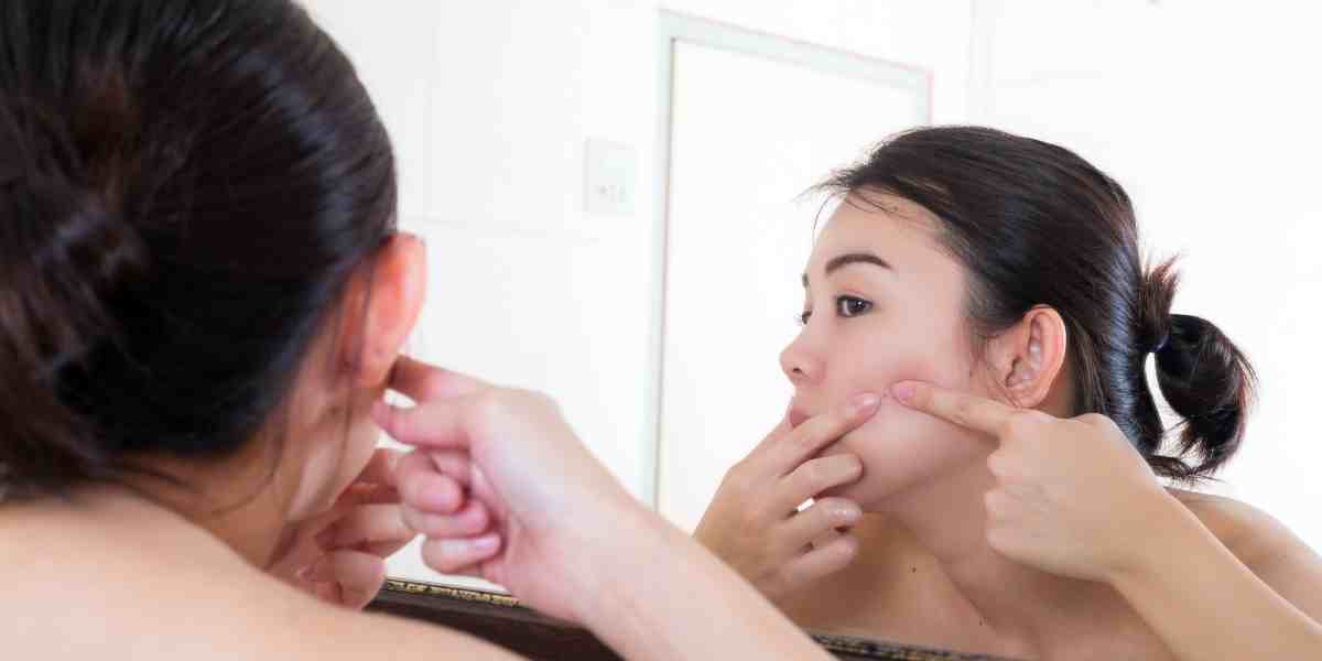 Dermatolog mengingatkan bahwa memencet jerawat di area wajah tertentu bisa memicu infeksi berbahaya dan bahkan berujung fatal jika tak ditangani dengan benar.