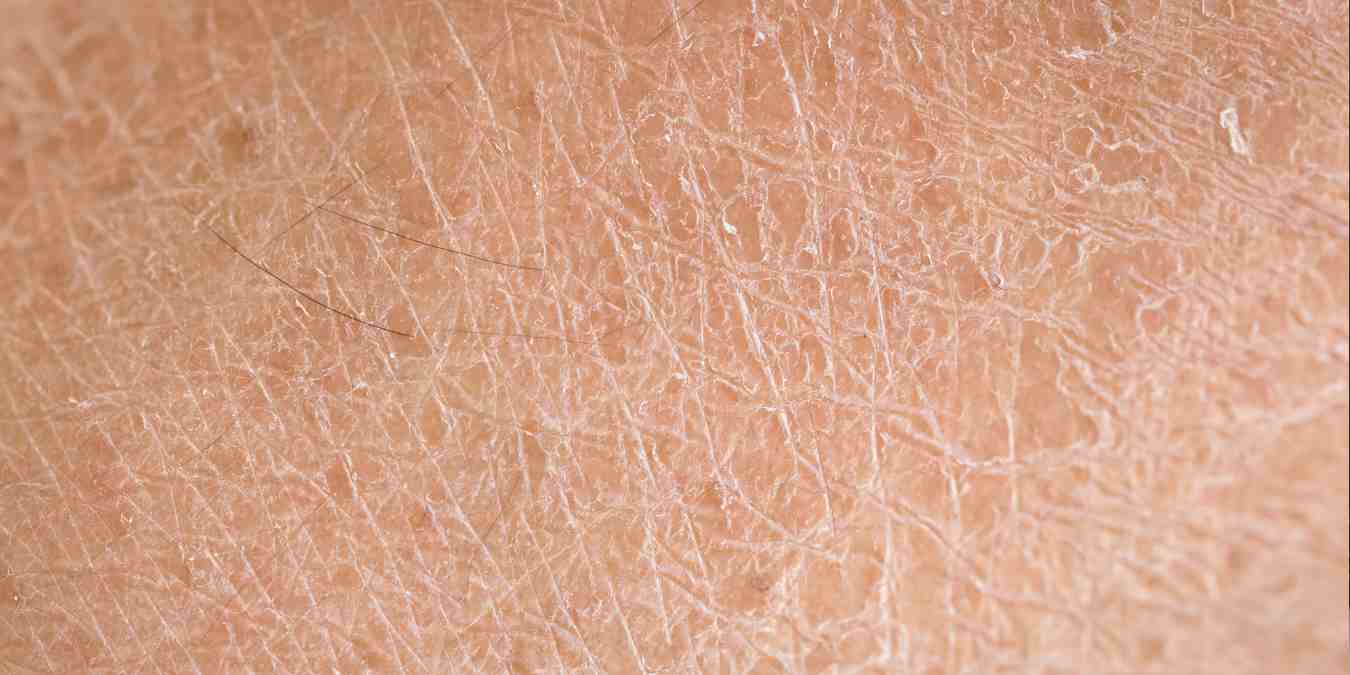 Kulit bersisik bukan berarti jorok atau menular. Psoriasis adalah penyakit autoimun yang butuh pemahaman dan empati, bukan stigma.