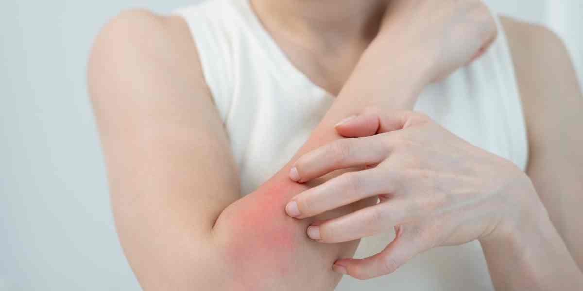 Tiba-tiba gatal dan muncul bentol di kulit? Jangan panik, bisa jadi biduran! Kenali penyebabnya sebelum makin parah.