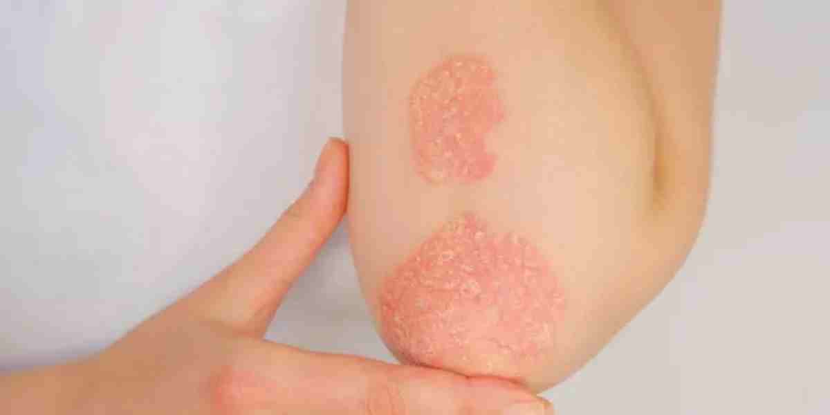 Psoriasis bukan karena jorok atau salah sabun. Kenali pemicunya, kendalikan gejalanya, dan tetap percaya diri menjalani hidup.