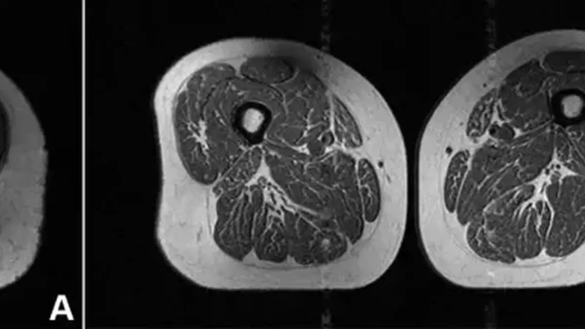 Visual perbandingan lemak tubuh manusia dengan daging berlemak memicu perhatian publik terhadap bahaya konsumsi makanan ultra proses (Radiological Society of North America/health.detik.com)