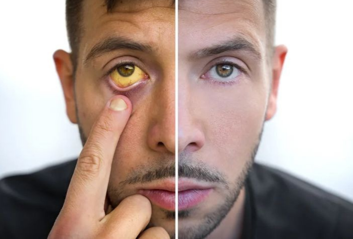 Penyakit kuning atau jaundice adalah kondisi ketika kulit dan mata tampak menguning akibat tingginya kadar bilirubin.