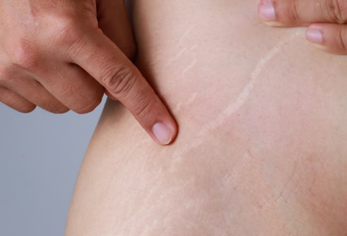 Temukan 7 rekomendasi krim penghilang stretch mark terbaik dan aman digunakan. Pinterest