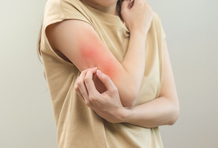 Gatal akibat alergi sering membuat aktivitas terganggu. Kenali penyebab, gejala, dan pilihan obat yang bisa membantu meredakan gatal agar kulit kembali sehat.