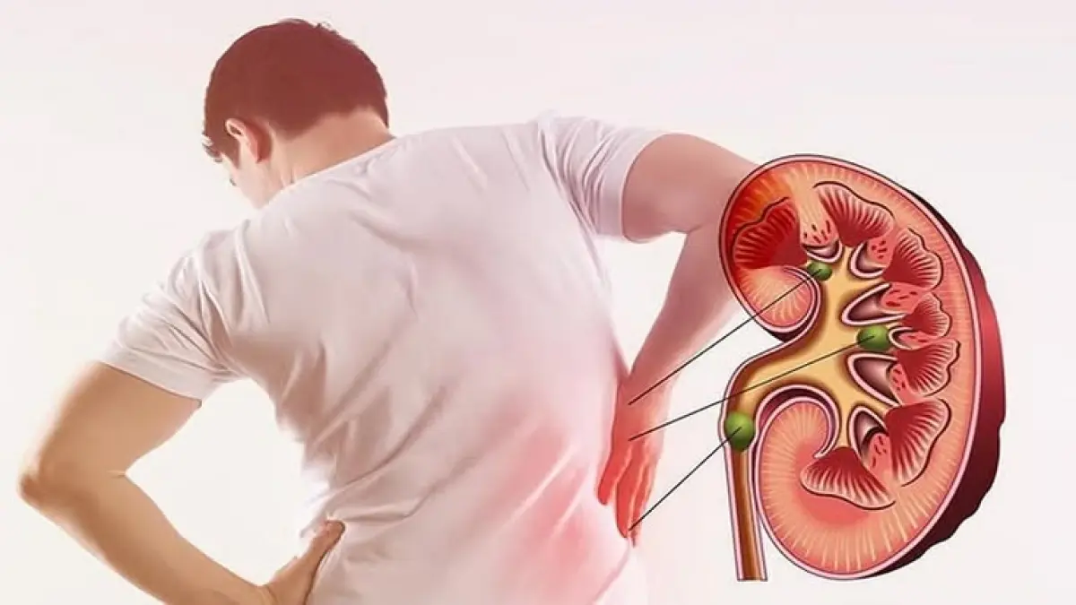 12 kebiasaan yang bisa merusak ginjal menurut dokter, mulai dari kurang minum air, konsumsi garam berlebihan, hingga terlalu sering minum minuman manis (Pinterest).
