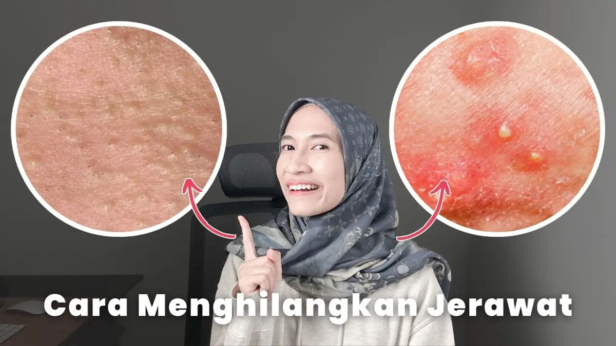 Cara Menghilangkan Jerawat secara medis dan tepat! Ketahui tingkat keparahan, panduan skincare retinoid, hingga pola makan sehat dari pakar di sini.