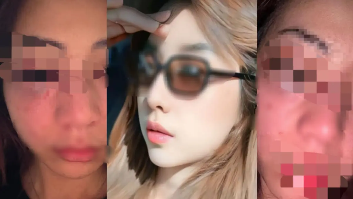 Ni Made Ari Darma Astitidewi, 25 tahun, mengalami luka-luka di seluruh tubuh diduga akibat kekerasan yang dilakukan kekasihnya, seorang dokter berinisial I Komang Aditya Arya Prayoga, 31 tahun.(Istimewa)
