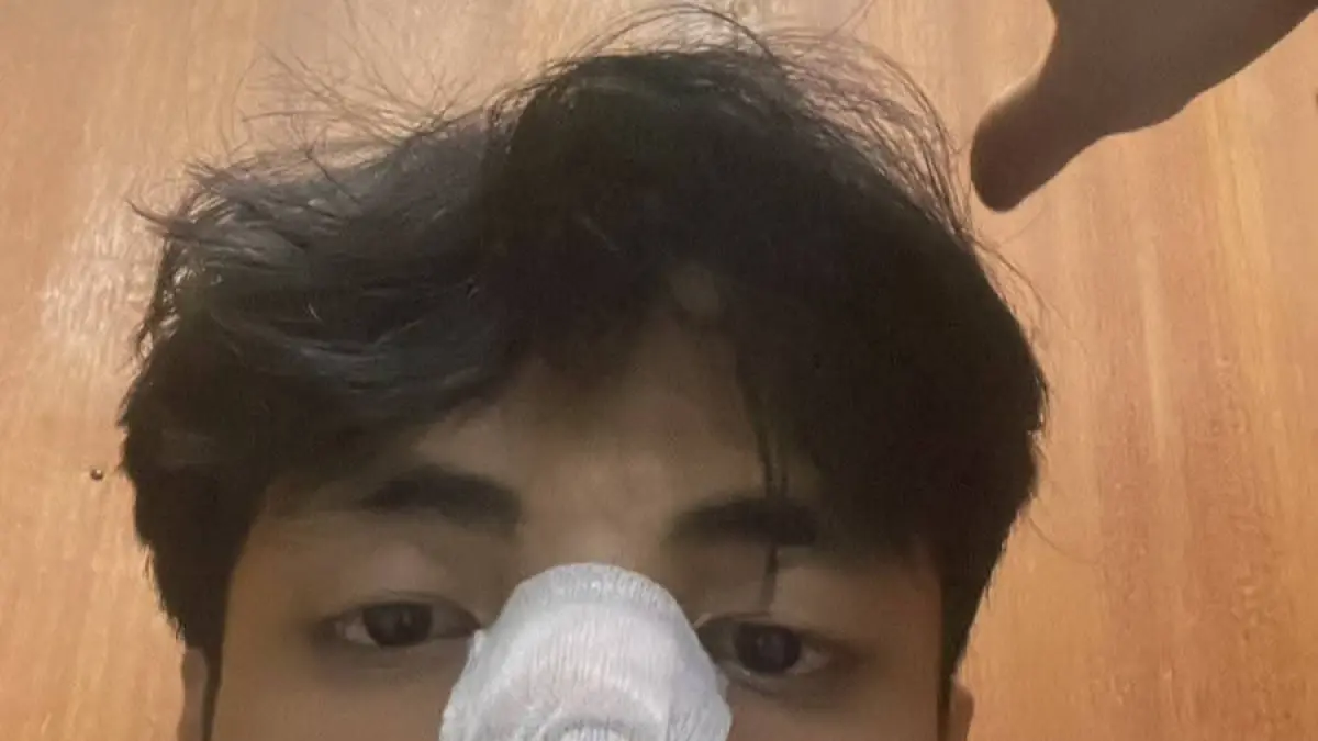 Seorang Aparatur Sipil Negara (ASN) di lingkungan Pemerintah Kabupaten Tabanan berinisial IGN CEP, 26 tahun, menjadi korban penganiayaan brutal di Desa Kukuh, Kecamatan Marga, Tabanan. Kasus ini dilaporkan ke Polres Tabanan sejak 15 Juni 2026, namun hingga kini pelaku belum ditangkap.(Istimewa)