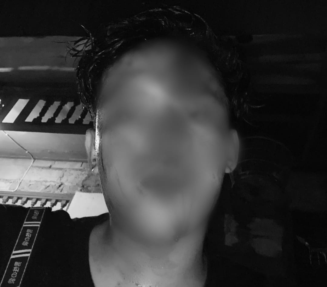 BABAK BELUR: Darah bercuxuran di wajah Muhamad Zainullah, 19, luka robek bagian kepala lantaran dikeroyok depan RS Wangaya