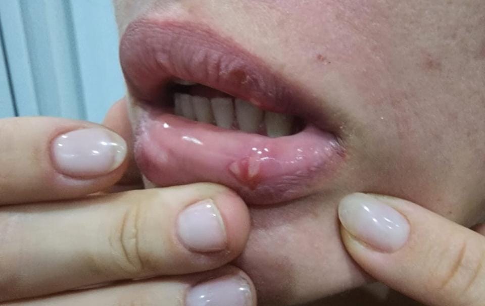 BIBIR PECAH: Wanita asal Ukraina Khodzhaiva Kat, bibir sampai luka pecah dihajar kekasihnya.