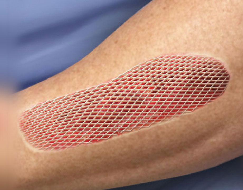 SKIN GRAFT: Prosedur memindahkan kulit yang sehat ke bagian tubuh lain yang memerlukan kulit baru. (dr. Tiza Murtia Margha For Radar Bali)