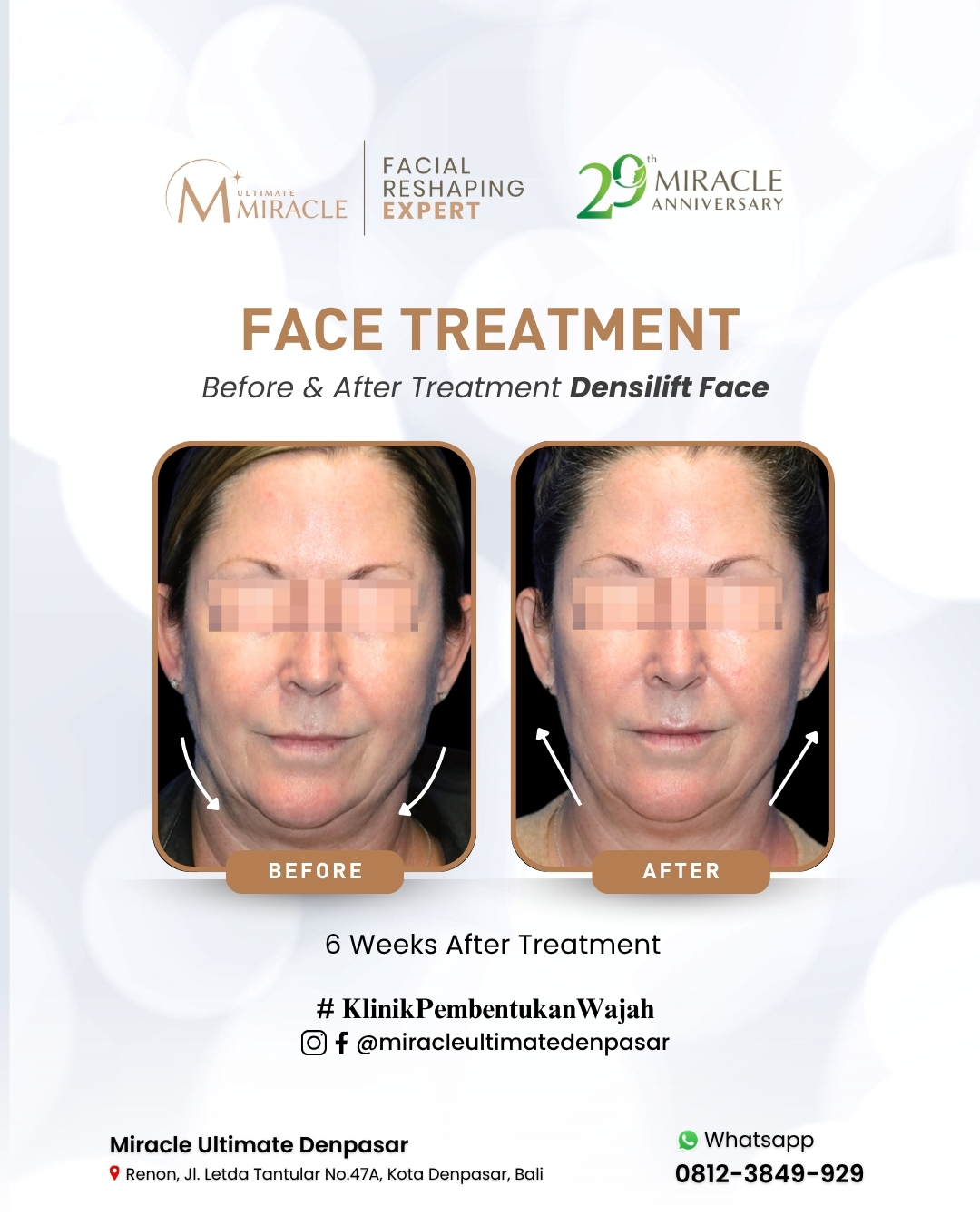 Miracle Ultimate menghadirkan inovasi melalui peluncuran treatment terbaru di bidang facial reshaping yang akan diselenggarakan pada 8 November 2025 mendatang di Hotel Maya Sanur.