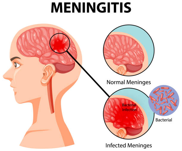 Ilustrasi alur gangguan penyakit Meningitis dalam grafis. (ist)