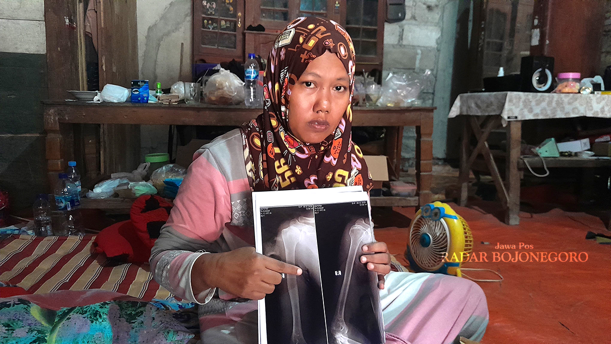 PATAH TULANG: Listiana menunjukkan hasil rontgen suaminya, yakni Sumar. Korban tragedi lift crane RS PKU Muhammadiyah Blora mengalami patah tulang rusuk. (ISTIMEWA/RADAR BOJONEGORO)