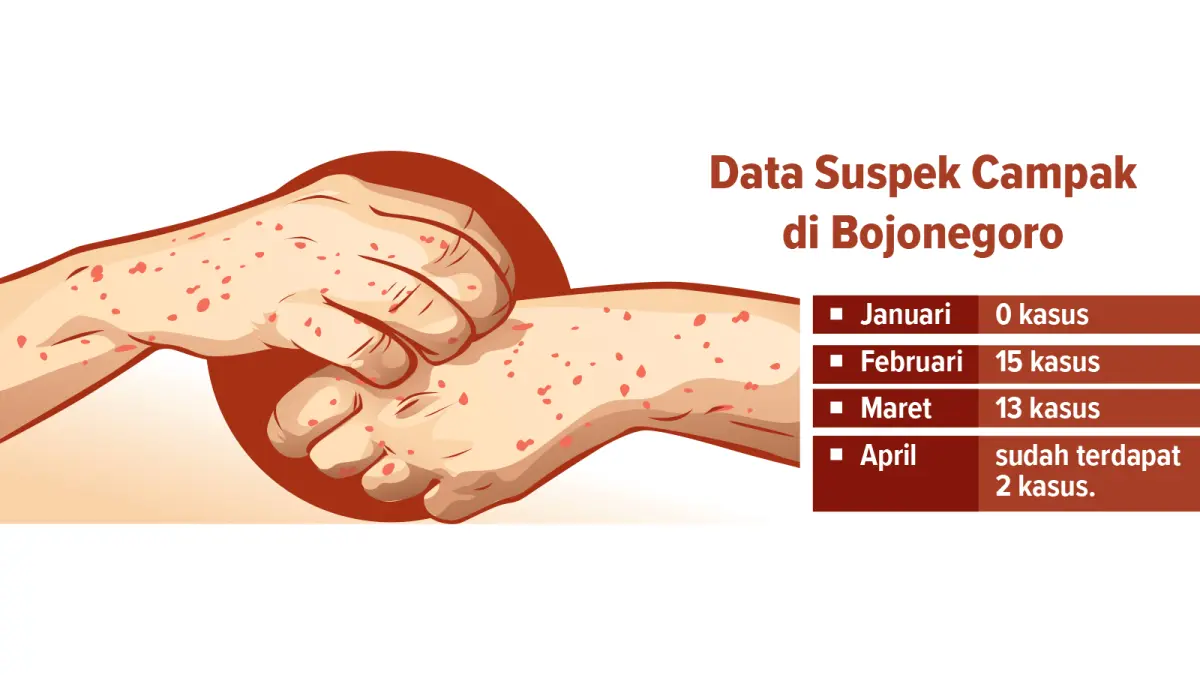 Infografis Kejadian Campak di Bojonegoro (AINUR OCHIEM/RADAR BOJONEGORO)