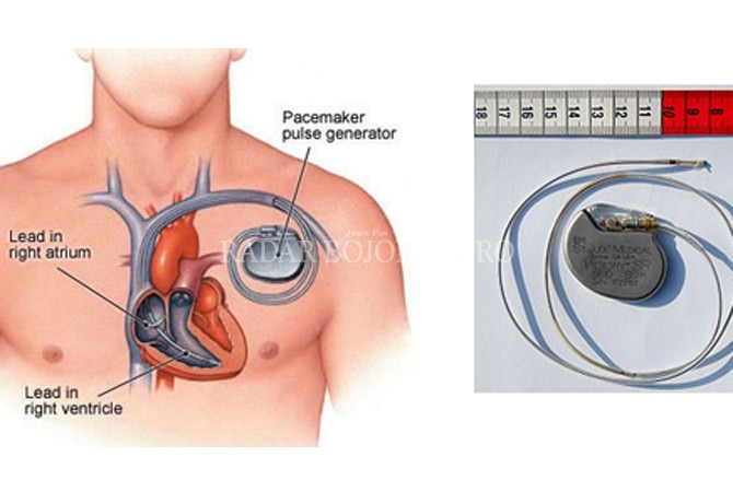 Pertama di Bojonegoro, Pemasangan Pacemaker Permanen