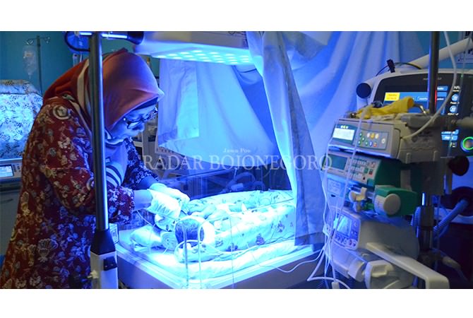 Anindita Aninda, Bayi Kembar Siam Jalani Terapi Blue Light