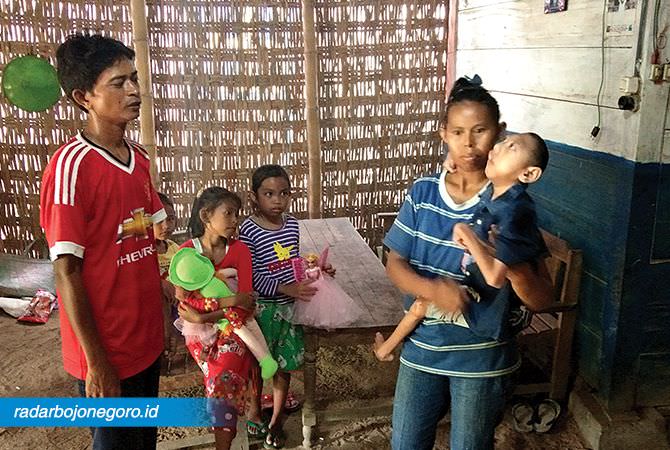Candra, Anak 14 Tahun Penderita Mikrosefalus