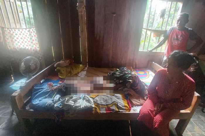 Sherly Putri Sugianto yang tak berdaya di kasur dengan luka bakar di punggung hingga pantat.