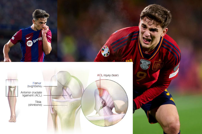Pemain Barcelona dan Spanyol Gavi mengalami cidera lutut ACL (Ligamen Anterior Cruciate).