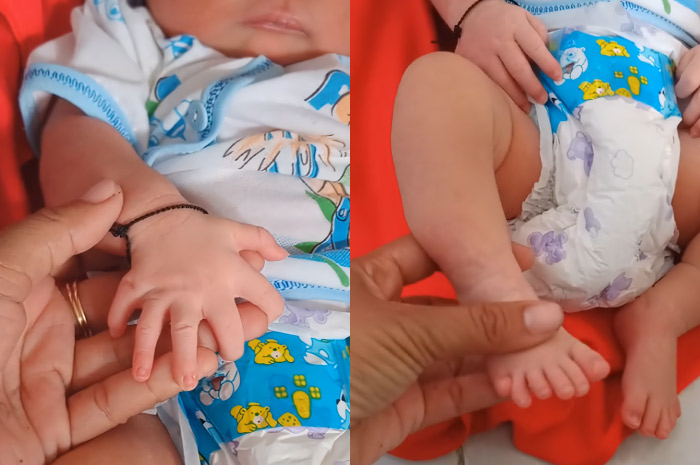 Tangkapan layar video viral seorang bayi yang terlahir dengan kondisi Polidaktili.