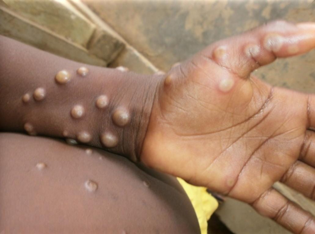 Gejala yang disebabkan oleh penyakit Monkey Pox atau Mpox
