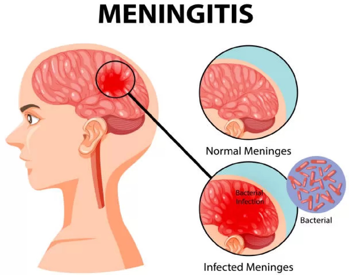 Berikut Penyebab Meningitis dan Cara Menanggulangi Meningitis