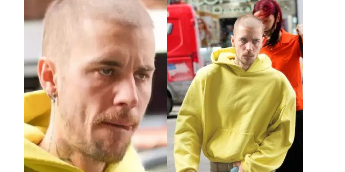 Kondisi Justin Beiber yang tampak beda