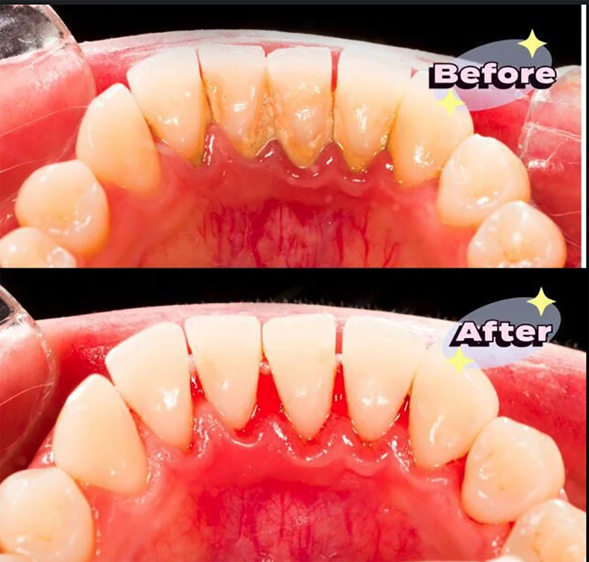 Cara Scalling Gigi Tanpa Gratis Cukup Menggunakan BPJS Kesehatan