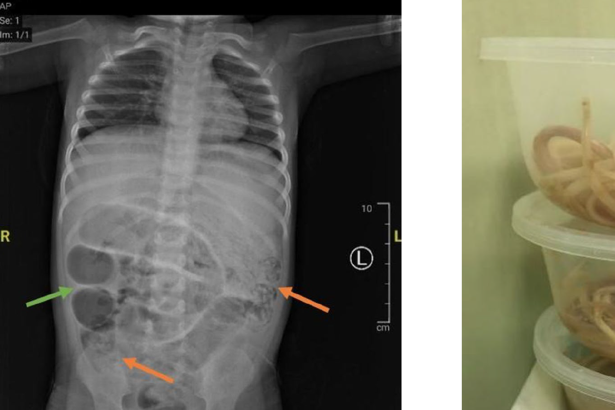 Hasil CT Scan milik anak yang berusia 3 tahun.