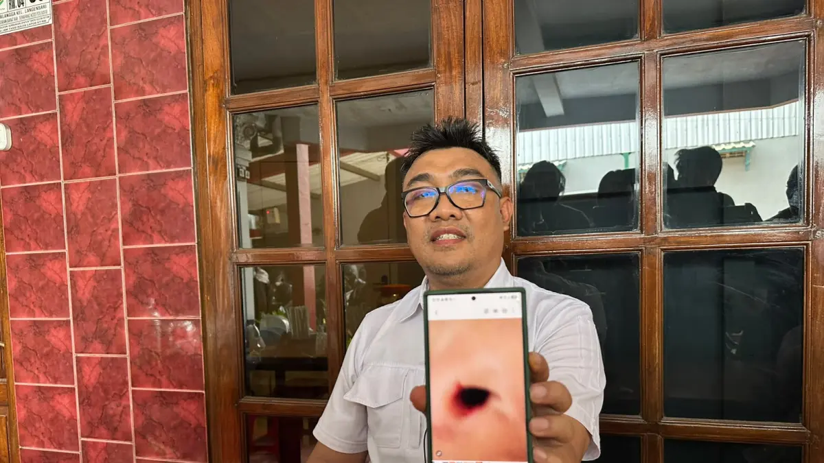 Ayah korban Arief Prasetyo 48, saat menunjukan luka lebam akibat perundungan yang diterima di SD Hj Isriati Moenadi Ungaran.