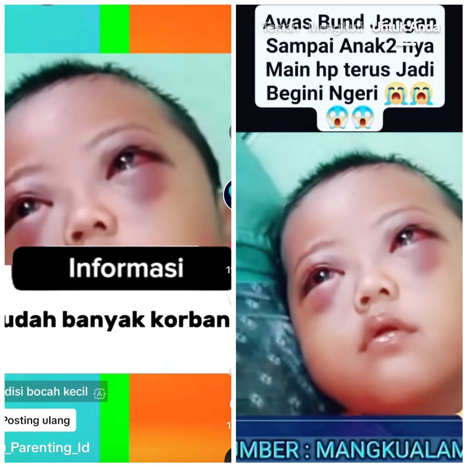 KELIRU: Cuplikan video mata anak kecil bengkak dan merah yang di unggah di dua akun Tiktok