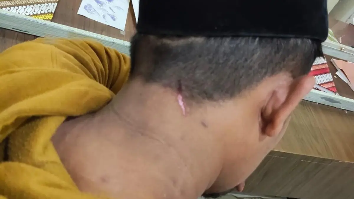 BUKTI KEKERASAN: Khalik saat mengalami luka dileher belakang akibat dipukul oleh Barri pada Jumat (20/2) sore.