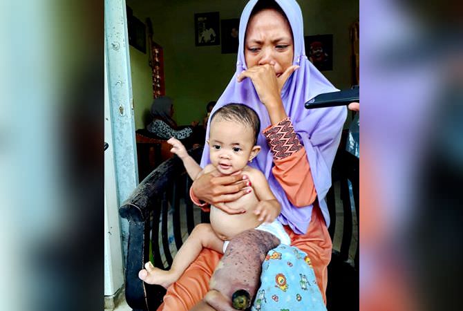 Nur Anisa Maharani, Bayi 7 Bulan Menderita Lymphangioma sejak Lahir