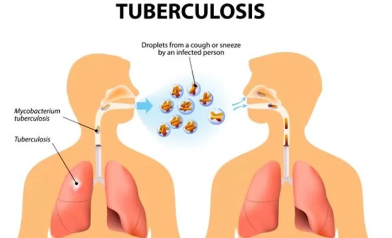 TB disebabkan oleh bakteri Mycobacterium tuberculosis yang menyebar melalui udara dan menular.