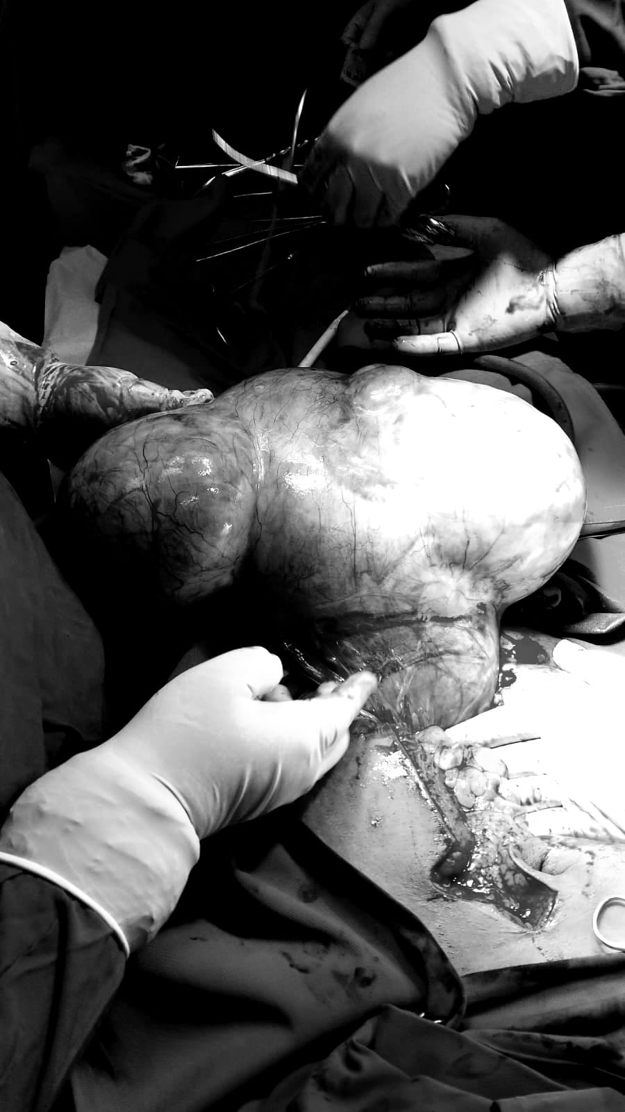 LANCAR: Tim anestesi dan tim bedah RSUD Genteng berhasil mengangkat tumor Giant Ovarian Tumor dengan berat 4.910 gram dalam operasi pada Senin (29/1).