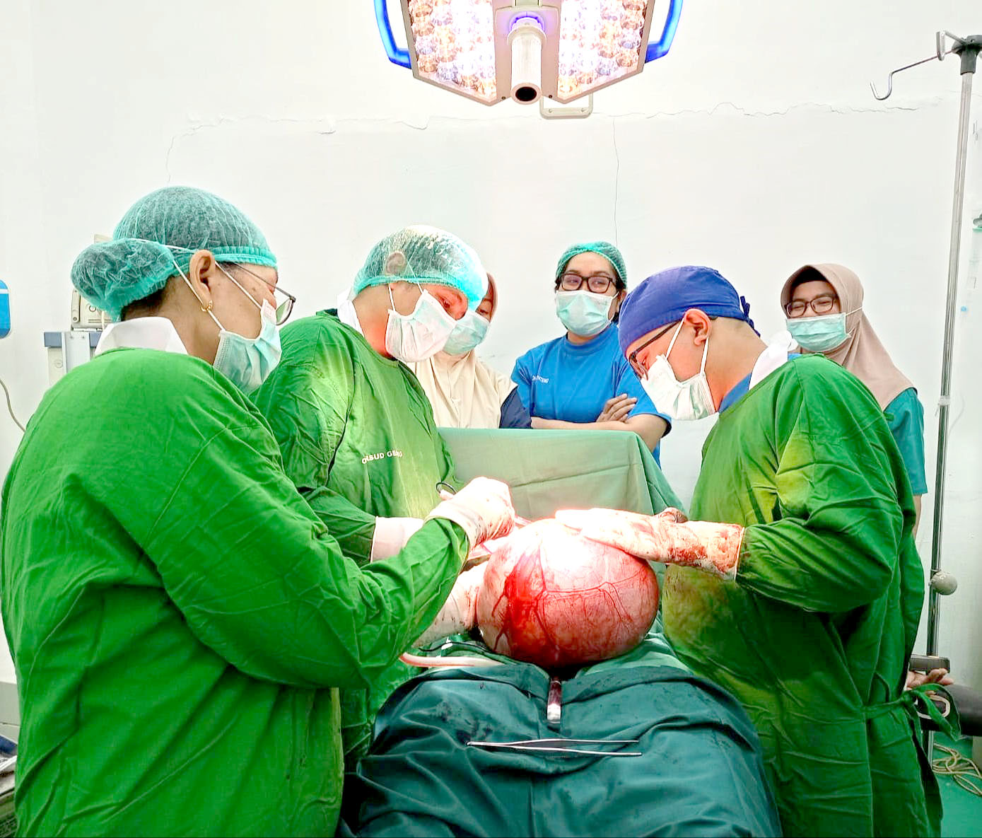 OPERASI: Proses pengangkatan tumor kista seberat 7,1 kilogram yang melibatkan dr Y. Rendy Tarigan SpOG, dr Nurul Huda SpB, dr Komang Ayu SpAn, dan tim bedah RSUD Genteng pada Jumat (23/2).