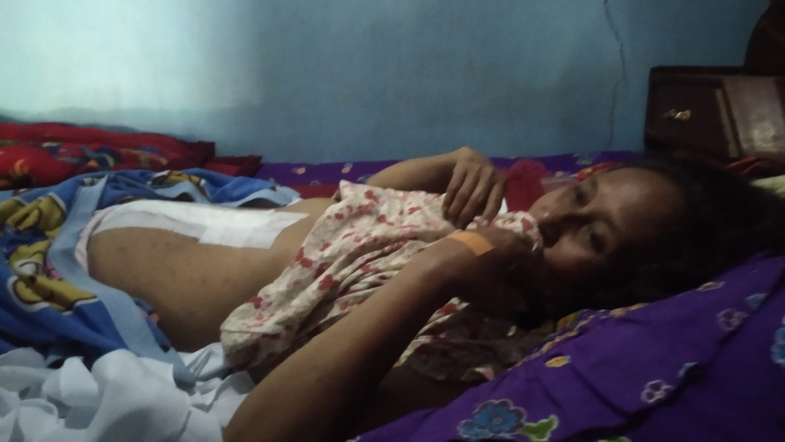 LEMAS: Sumiati menunjukkan bekas operasi di perutnya setelah pengangkatan giant tumor kista seberat 7,1 kilogram di rumahnya Dusun Sidomulyo, Desa Jambewangi, Kecamatan Sempu Rabu (28/2).
