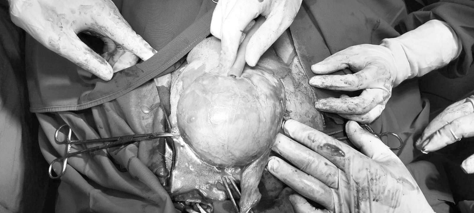 OPERASI: Tim bedah RSUD Genteng mengangkat tumor testis pada pasien.