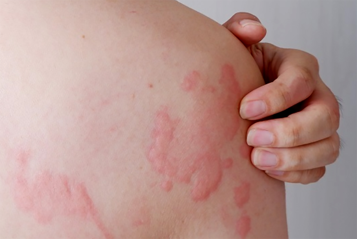 Ilustrasi gatal-gatal pada kulit. (Kalteng Pos)