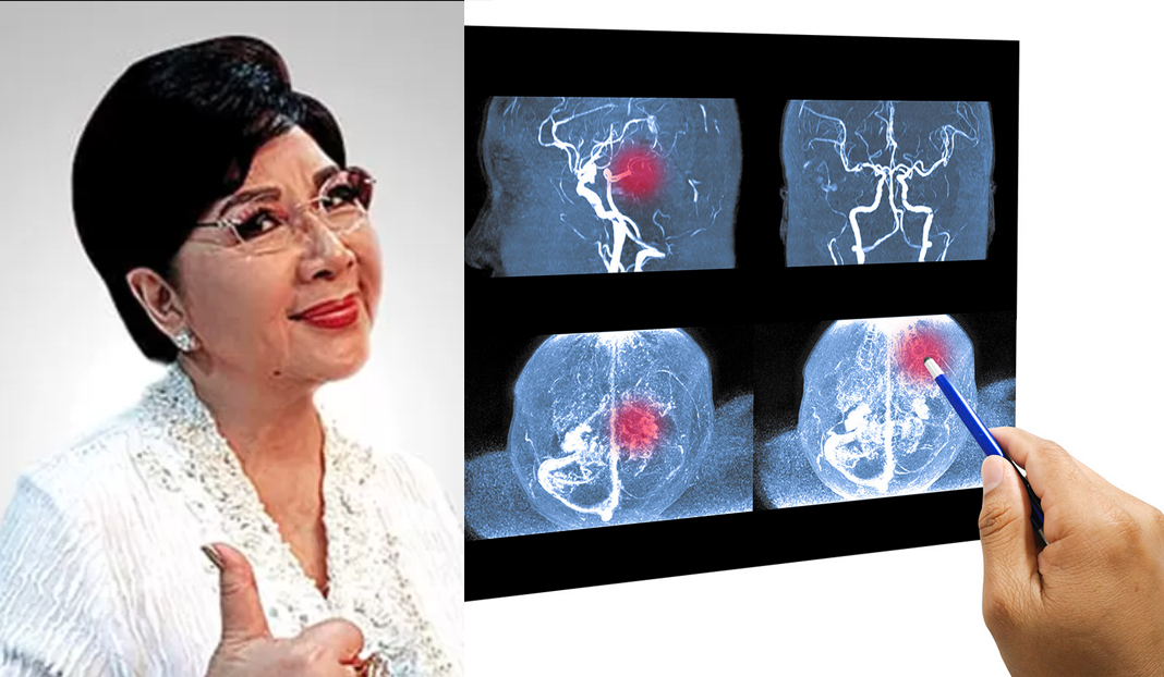 ILUSTRASI: Artis senior Titiek Puspa meninggal dunia setelah mengalami pembuluh darah pecah di otak. (foto: JawaPos.com dan rspondokindah.co.id)